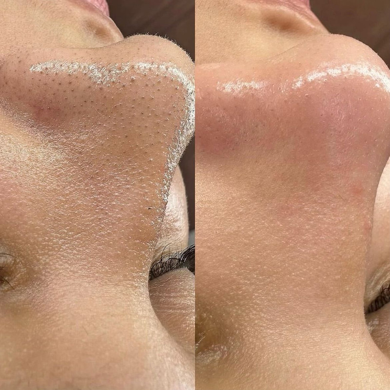 毛穴ケア(ディープクレンジング)